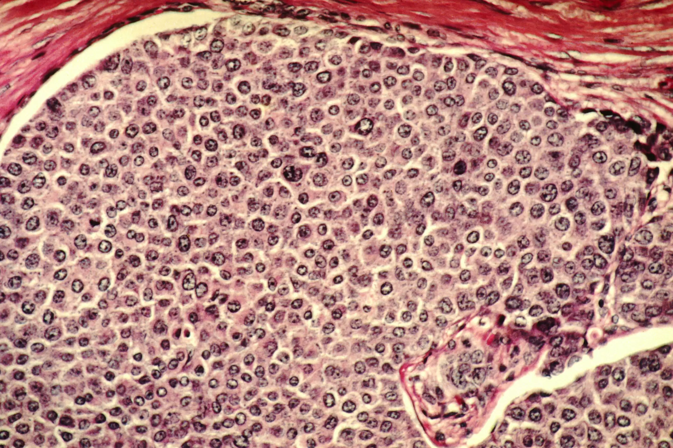 Stanford Araştırmacıları, Kanser Hücrelerinin Kendi Kendini Yok Etmesini Sağlayan Molekül Geliştirdi