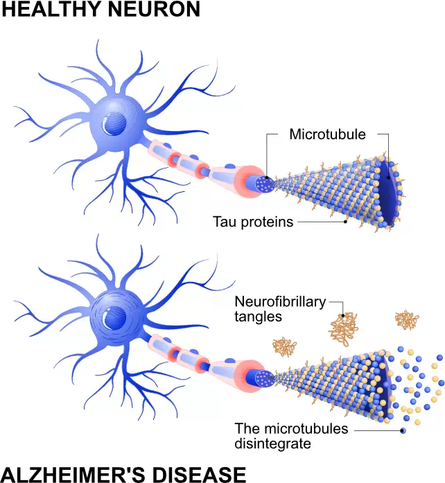 Alzheimer’a Çare: Tek Bir Enzimle Hastalık Tersine Çevrilebilir!