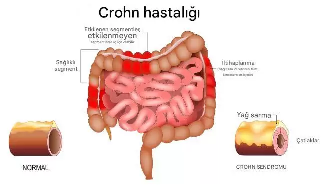 Yeni Keşfedilen Molekül Bağırsak Hasarını Onarıyor ve Kanseri Baskılıyor