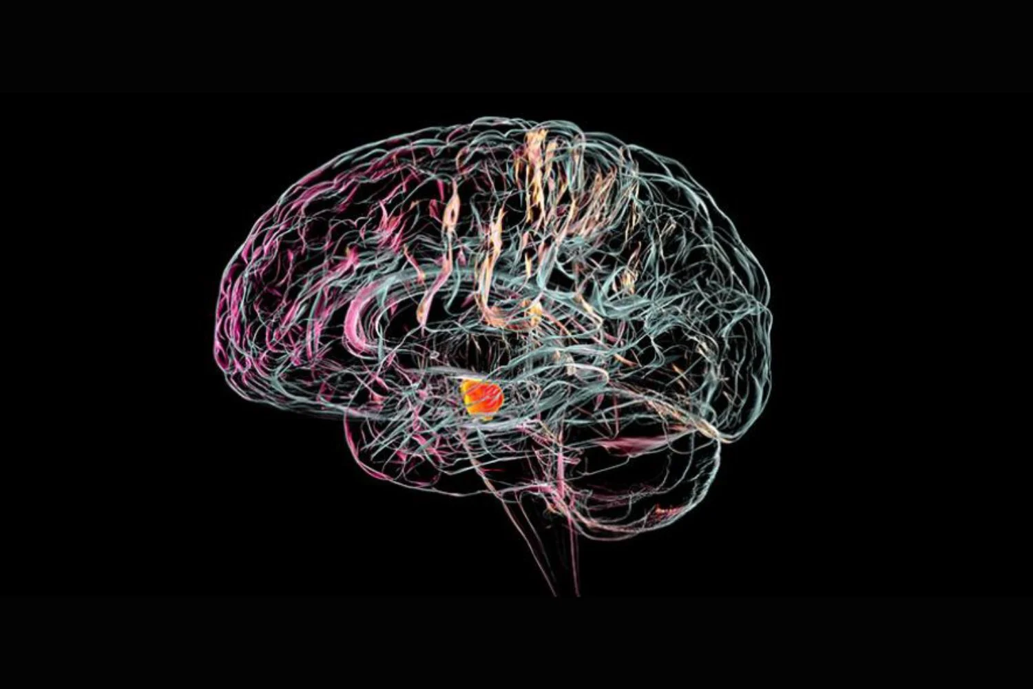 Parkinson’a Çare mi Geliyor? Bilim İnsanları Beyin İmplantı Üzerinde Çalışıyor!